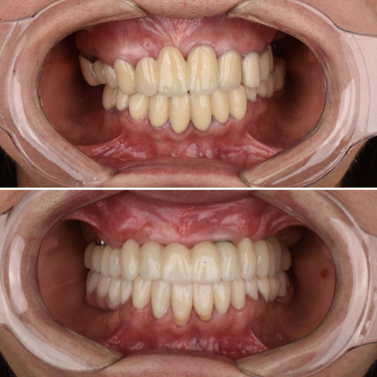Rehabilitación arco completo sobre implantes — Protdent